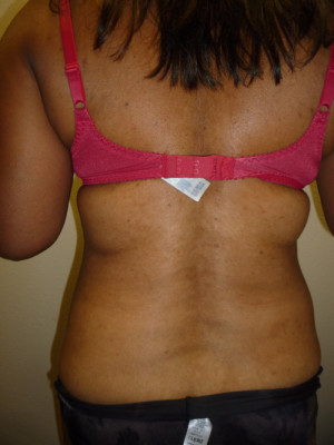 Liposuction Before and After Results