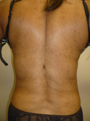 Liposuction Before and After Results