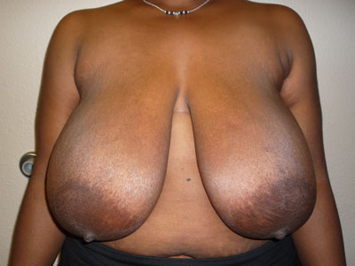 Breast Reduction Before and After