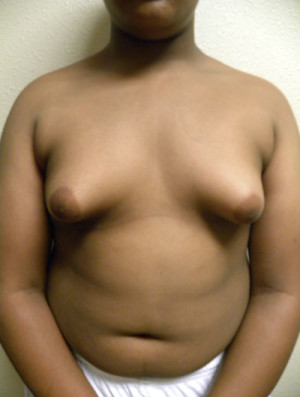 Gynecomastia Before and After Results