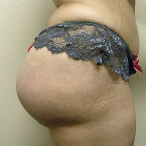 Fat Transfer to buttocks after photo by Dr. Heinsten in Fort Worth, TX