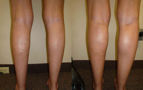 Calf Implants Results