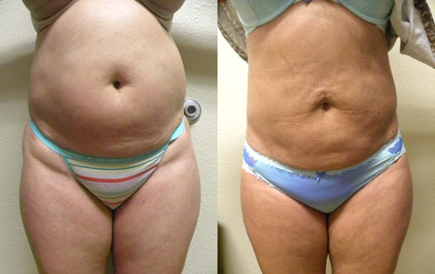 Liposuction Before and After Photos