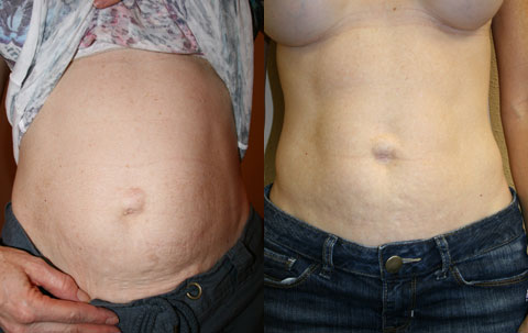 Mini-Tummy Tuck Results