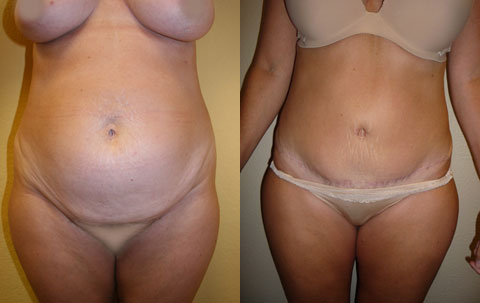 Abdominoplasty Before and After Photos